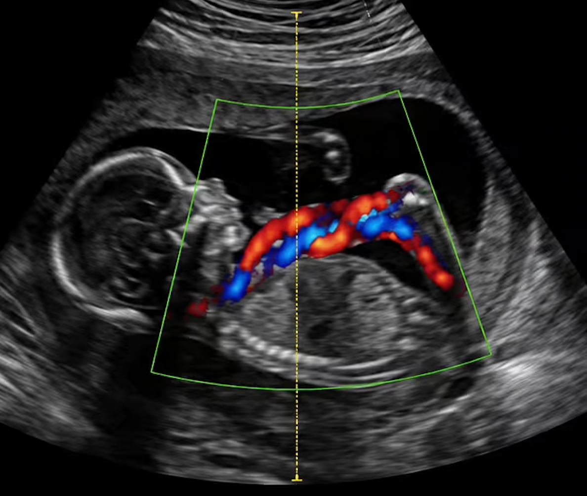 Ecografía Obstétrica Doppler